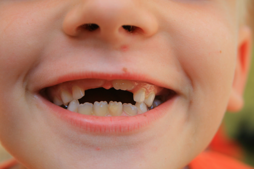 La Salida Y Caída De Los Dientes De Leche En La Infancia